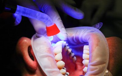 What is Tooth Decay?